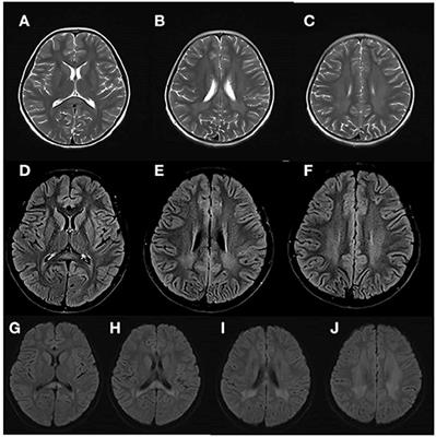 Case Report: Compound Heterozygous Variants of SLC13A3 Identified in a Chinese Patient With Acute Reversible Leukoencephalopathy and α-Ketoglutarate Accumulation